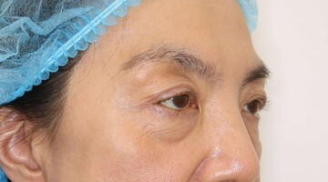 すなおクリニックの目元・クマ・眉下・涙袋整形の症例写真[ビフォー]