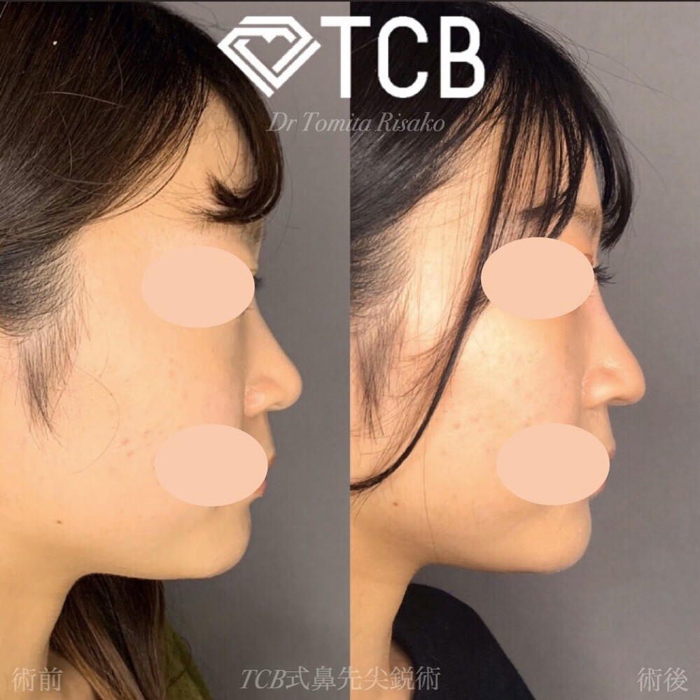 ツンとした鼻先で横顔美人 鼻の整形の症例写真 画像 Tcb東京中央美容外科 渋谷西口院 Cs 美容医療の口コミ広場