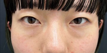 AI Beauty Clinicの目元・クマ・眉下・涙袋整形の症例写真[ビフォー]