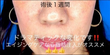 50代女性のほうれい線脂肪注入の症例写真[アフター]