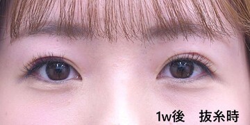 医療法人秀晄会 心斎橋コムロ美容外科クリニックの症例写真[アフター]