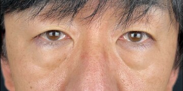 AI Beauty Clinicの目元・クマ・眉下・涙袋整形の症例写真[ビフォー]