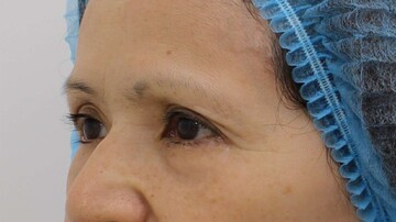 すなおクリニックの目元・クマ・眉下・涙袋整形の症例写真[ビフォー]