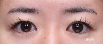 聖心美容クリニックの二重の症例写真[ビフォー]