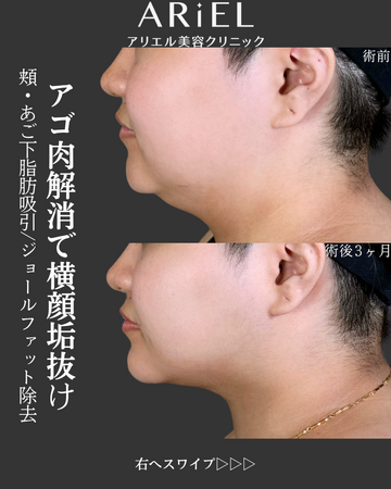 アリエル美容クリニック 郡山院の脂肪吸引の症例写真