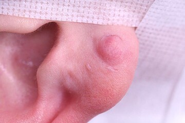 医療法人秀晄会 心斎橋コムロ美容外科クリニックの傷跡治療、ケロイドの症例写真[ビフォー]
