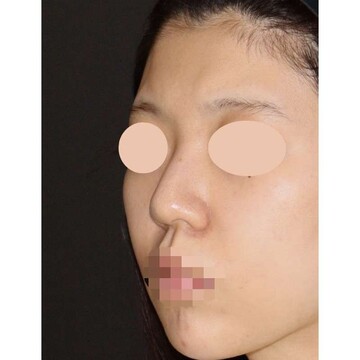 聖心美容クリニックの鼻の症例写真[ビフォー]