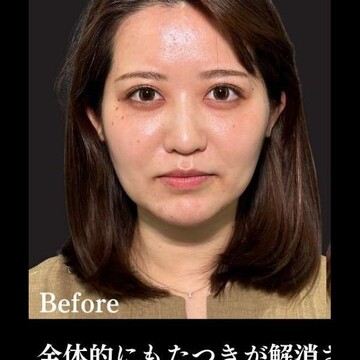 PRISM Beauty Clinicのリフトアップの症例写真[ビフォー]