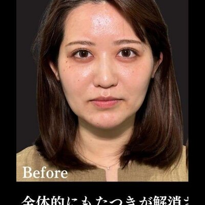 PRISM小顔美肌リフト 8本の症例写真[ビフォー]