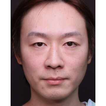 聖心美容クリニックの目元の症例写真[ビフォー]