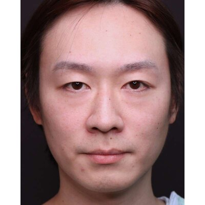 30代男性の裏ハムラ法で目元の影を改善（術後1ヶ月）の症例写真[ビフォー]