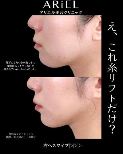 糸リフトの症例写真