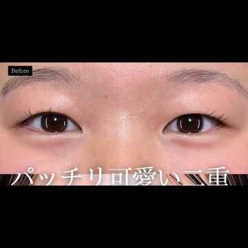 PRISM Beauty Clinicの二重の症例写真[ビフォー]
