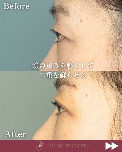 瞼の重みを軽減「眉下切開」の症例写真