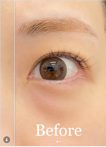 LIBER CLINIC （リベルクリニック）の目元・クマ・眉下・涙袋整形の症例写真[ビフォー]