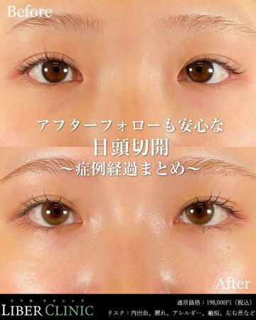LIBER CLINIC （リベルクリニック）の目・二重整形の症例写真