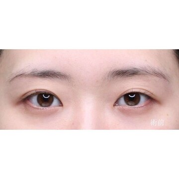 聖心美容クリニックの二重の症例写真[ビフォー]