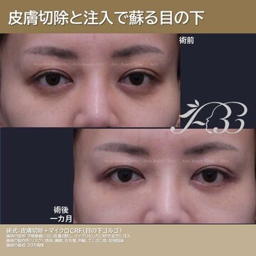 あいちビューティークリニック栄本院の目元・クマ・眉下・涙袋整形の症例写真