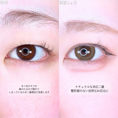 アリエルクイックループトリプルの症例写真
