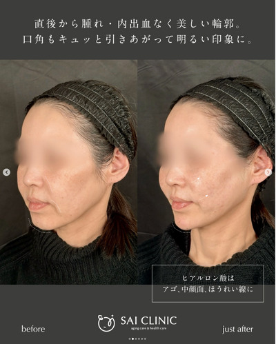 🪡糸リフト｜SAI LIFT STANDARD(18本)の症例写真
