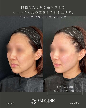 SAI CLINIC （サイクリニック）のリフトアップの症例写真