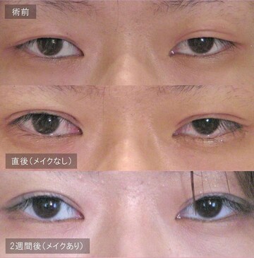 アーティスクリニックの目・二重整形の症例写真