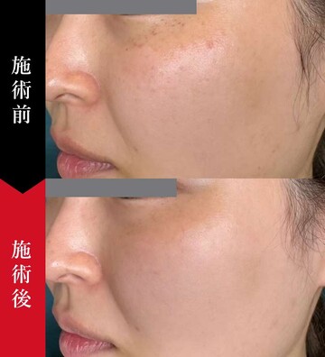 椿クリニックのシミ取り・肝斑・毛穴治療の症例写真