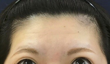しわボトックス（額）の症例写真[ビフォー]