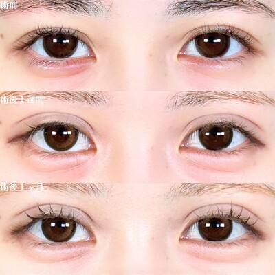 アリエルクイックループダブルの症例写真