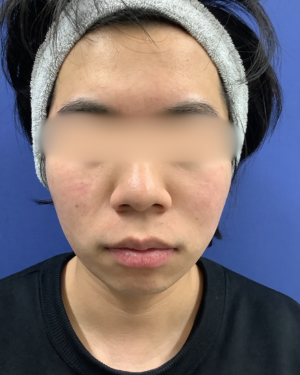 頬の赤み治療(ACRS 3回)の症例写真[アフター]