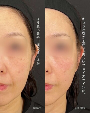 SAI CLINIC （サイクリニック）のリフトアップの症例写真