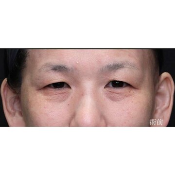聖心美容クリニックの目元の症例写真[ビフォー]