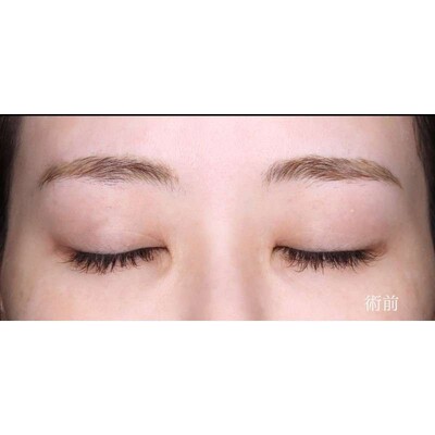 目上切開で目を寄せずに丸く自然な目元へ（術後6ヶ月）の症例写真[ビフォー]