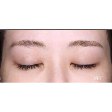 聖心美容クリニックの目元の症例写真[ビフォー]