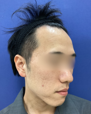 フェミークリニックの症例写真[アフター]