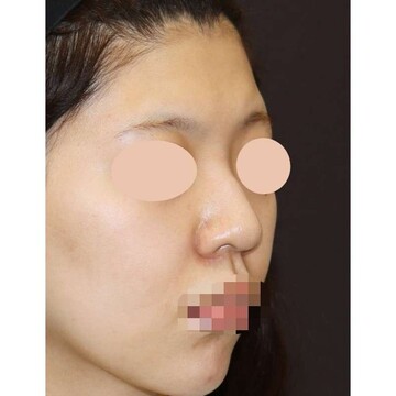 聖心美容クリニックの鼻の症例写真[ビフォー]