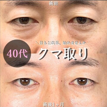アリエル美容クリニック 大宮院の目元・クマ・眉下・涙袋整形の症例写真