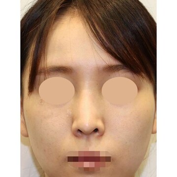 聖心美容クリニックのリフトアップの症例写真[ビフォー]