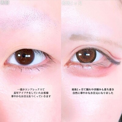 アリエルフォーエバークロス二重埋没法の症例写真