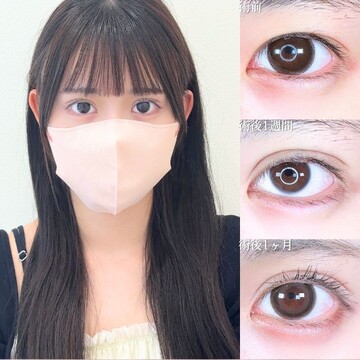 アリエル美容クリニック 大宮院の二重の症例写真