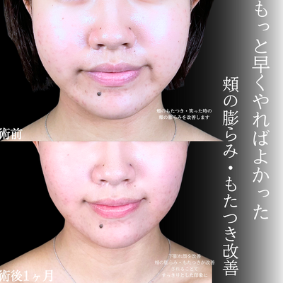 バッカルファット/エラボトックスの症例写真