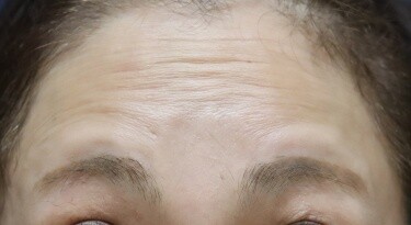 しわボトックス（額）の症例写真[ビフォー]
