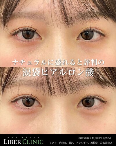 ナチュラル盛り涙袋の症例写真