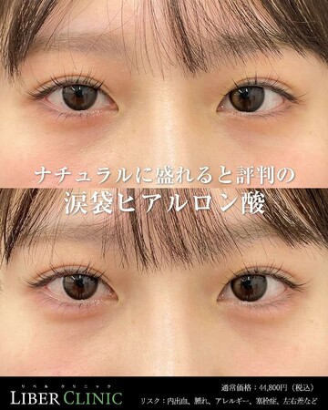 LIBER CLINIC （リベルクリニック）の目元・クマ・眉下・涙袋整形の症例写真