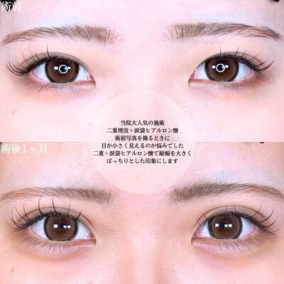 アリエルクイックループダブル二重埋没法/涙袋ヒアルロン酸の症例写真