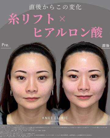 KNOT CLINIC AOYAMAのしわ・たるみ整形(注入、糸、フェイスリフト)の症例写真