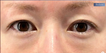 PRISM Beauty Clinicの目元・クマ・眉下・涙袋整形の症例写真[ビフォー]