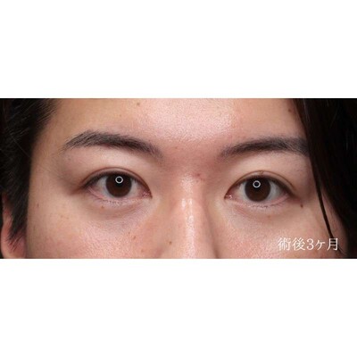 男性の裏ハムラ法で疲れ顔の目元を改善（術後3ヶ月）の症例写真[アフター]