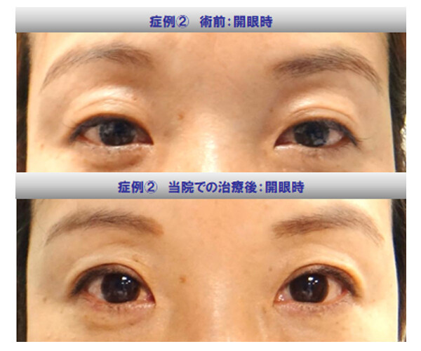 上瞼のたるみと窪みを埋没新挙筋法のみで改善 (目元のたるみ取り、目元のくぼみの症例写真・画像) - KUNOクリニック 麻布院 クリニック ...