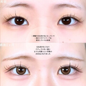 アリエル美容クリニック 大宮院の二重の症例写真
